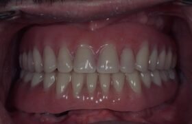 barre-sur-barre-1200x894